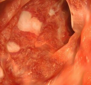 Ελκώδης Κολίτιδα