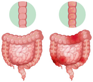 νόσος crohn