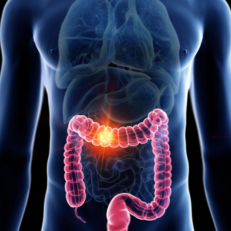 καρκίνος λεπτού εντέρου