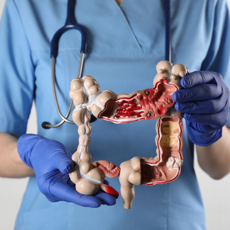 καρκίνος παχέος εντέρου