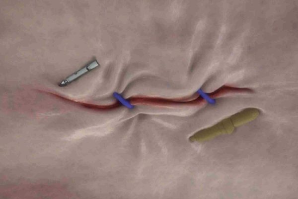 Ενδοβαριατρικό Σύστημα Apollo OverStitch