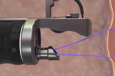 Ενδοβαριατρικό Σύστημα Apollo OverStitch