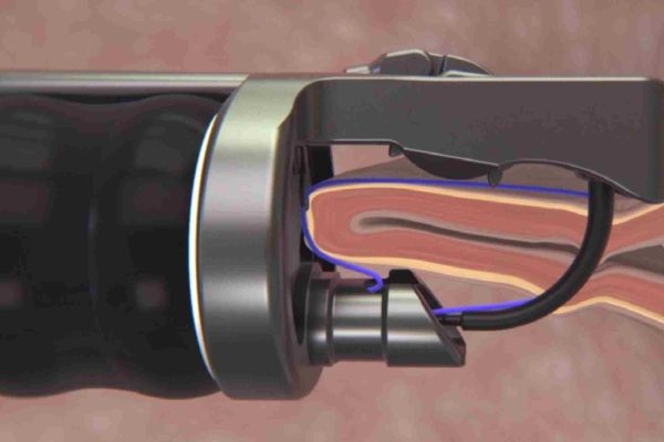 Ενδοβαριατρικό Σύστημα Apollo OverStitch