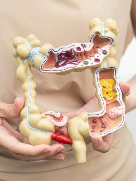 καρκίνος παχέος εντέρου