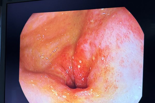 Γαστροσκόπηση